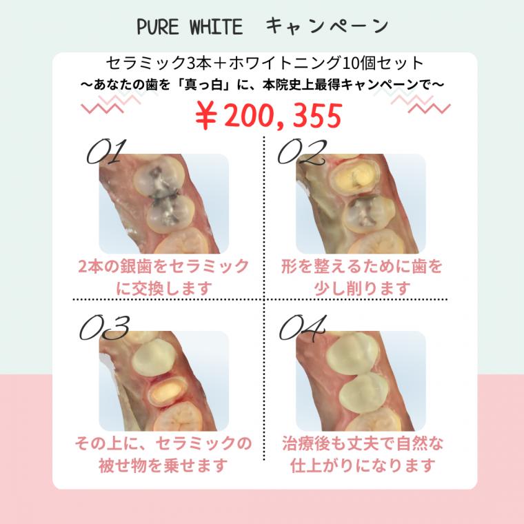 【期間限定!セラミック治療とホワイトニングの特別キャンペーンのお知らせ】