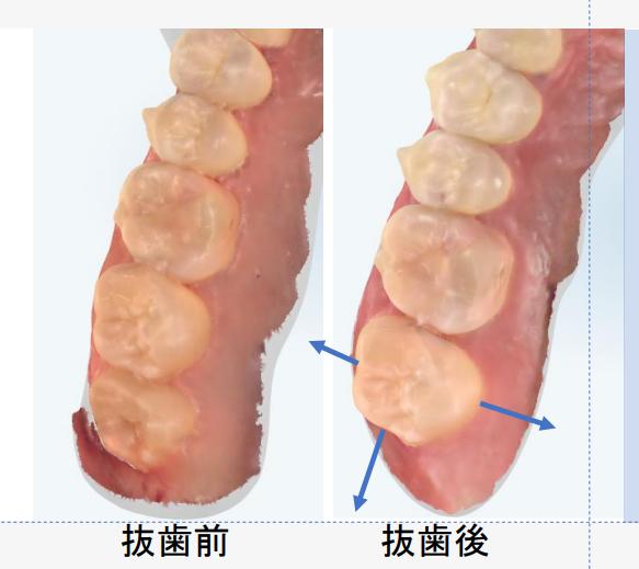 完全埋伏の親知らずを残すケースと抜くケースについての私の判断基準