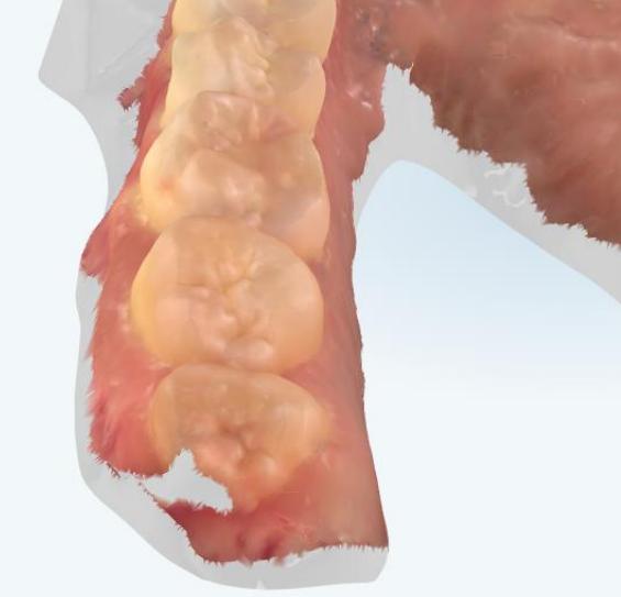 親知らずが矯正失敗につながるメカニズム