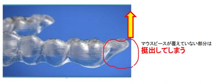 親知らずが矯正失敗につながるメカニズム