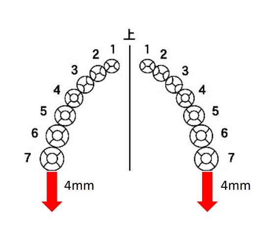 親知らずが矯正失敗につながるメカニズム