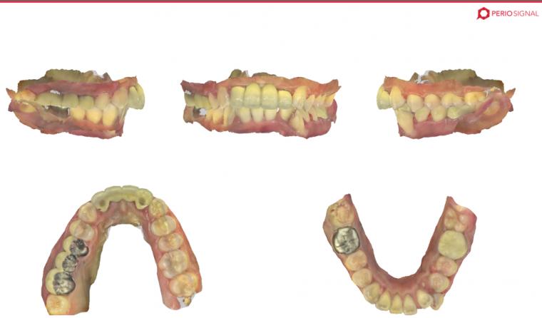 【2025年版】患者様へ 唾液測定ペリオシグナルで変わる歯科医療