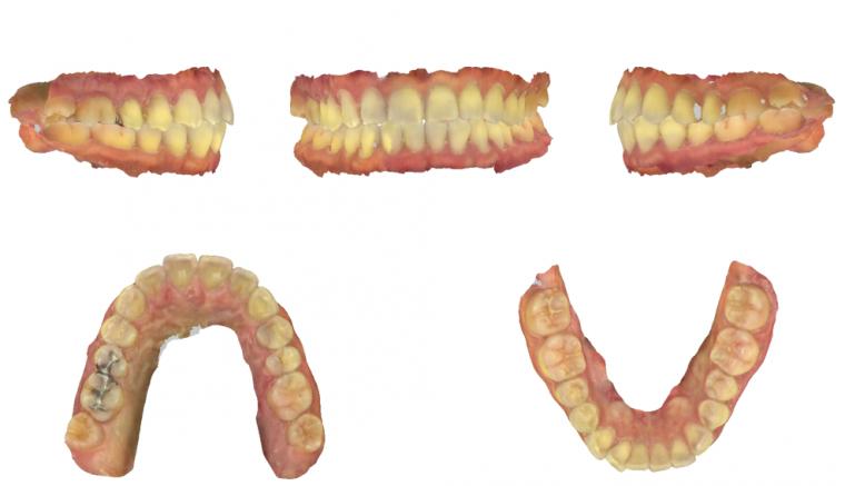 【2025年版】患者様へ 唾液測定ペリオシグナルで変わる歯科医療