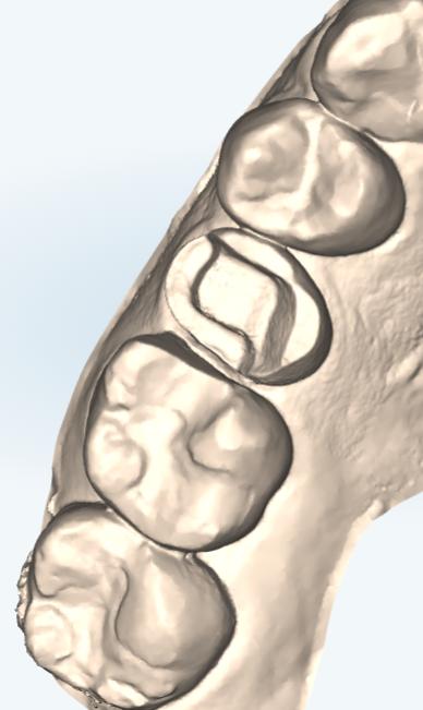 セラミック治療の正解 なぜ「2日に1回」執刀する歯科医師の形成は、ここまで美しいのか