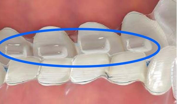 マウスピース矯正の落とし穴 　矯正したのに野菜が食べられなくなった本当の理由