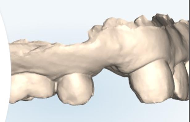 抜歯矯正とは何か インビザラインにおける診断と思考の実際