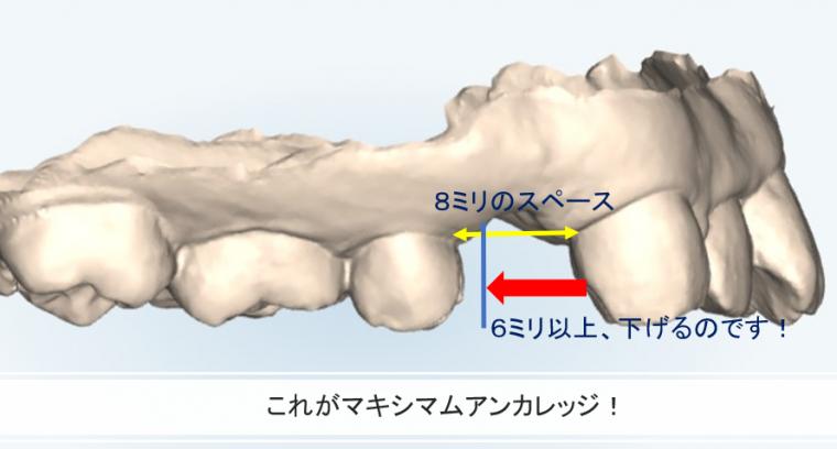 抜歯矯正とは何か インビザラインにおける診断と思考の実際