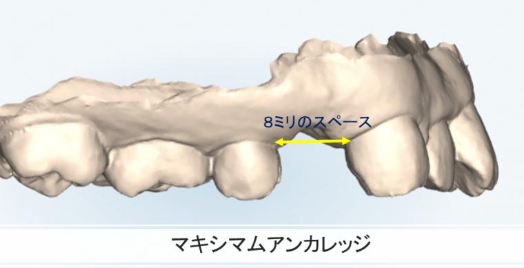 インビザラインにおける抜歯矯正と予測実現性の考え方
