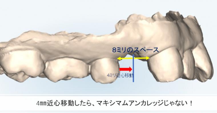 インビザラインにおける抜歯矯正と予測実現性の考え方