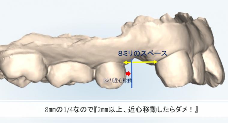 インビザラインにおける抜歯矯正と予測実現性の考え方