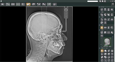 矯正治療の抜歯基準はセファロ分析だけでは決められない 現代矯正における現実的な判断軸
