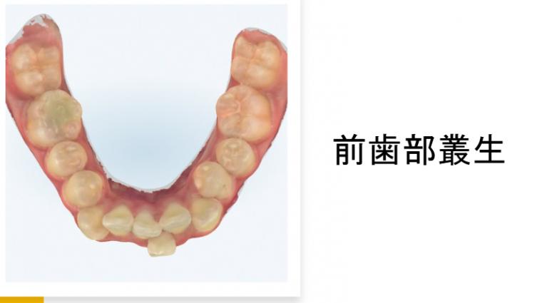 矯正治療の抜歯基準はセファロ分析だけでは決められない 現代矯正における現実的な判断軸