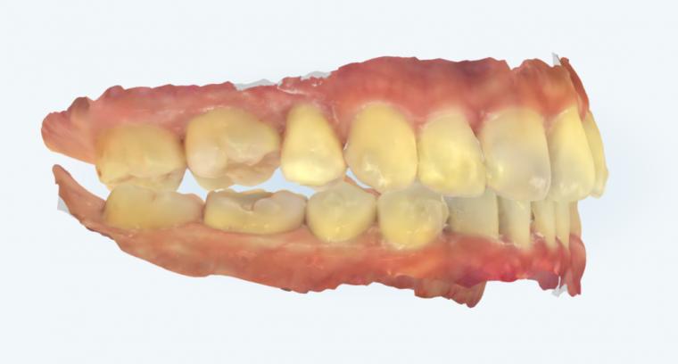 矯正治療の抜歯基準はセファロ分析だけでは決められない 現代矯正における現実的な判断軸