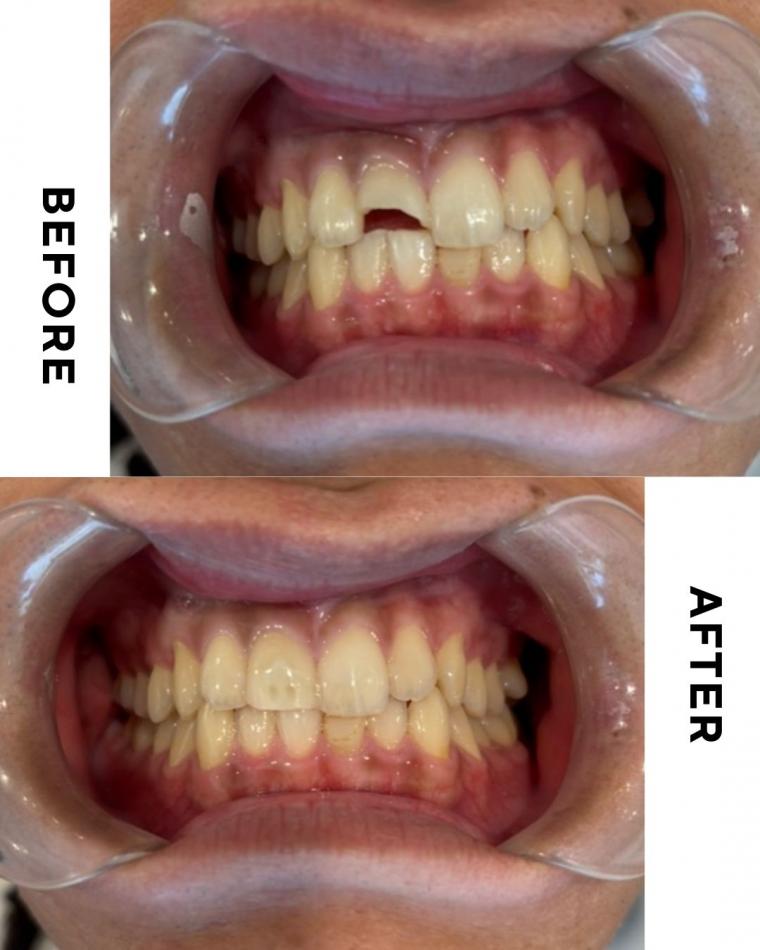 前歯が折れた!その日のうちに見た目と機能を回復させる「即日修復」