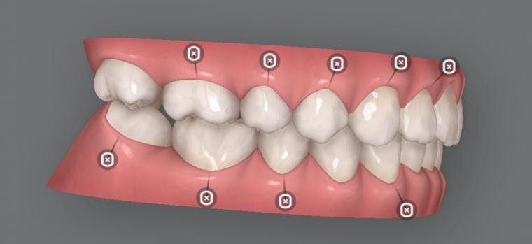 クリンチェックが劇的に使いやすくなる!「咬合平面傾斜角」の設定術