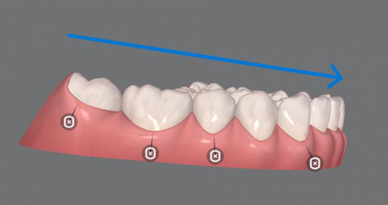 クリンチェックが劇的に使いやすくなる!「咬合平面傾斜角」の設定術