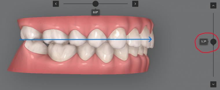 クリンチェックが劇的に使いやすくなる!「咬合平面傾斜角」の設定術