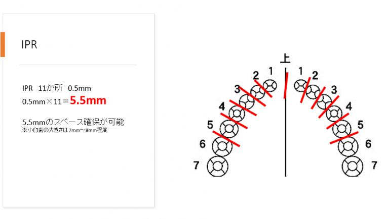 抜歯・非抜歯の境界線はどこ？「合計14.1mm」のロジック