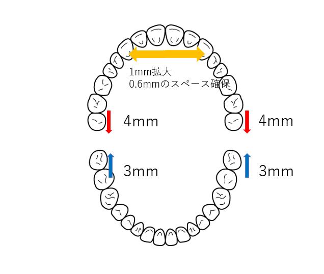 抜歯・非抜歯の境界線はどこ？「合計14.1mm」のロジック