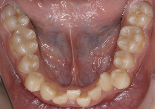 IPRは、どのタイミングで行うの？