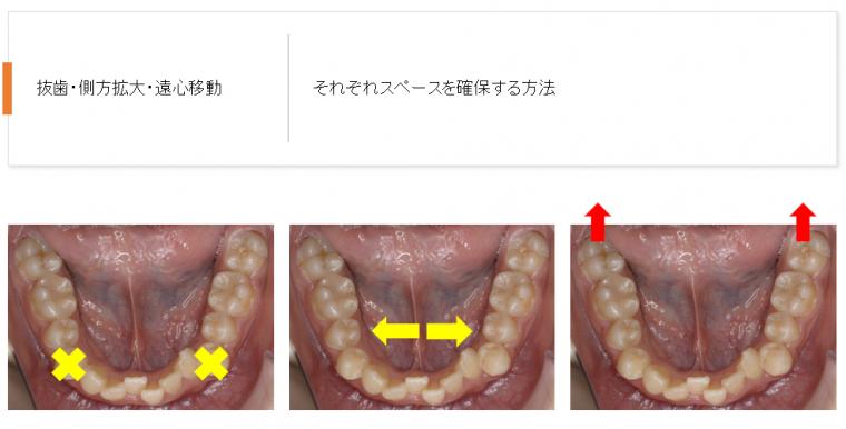 IPRは、どのタイミングで行うの？