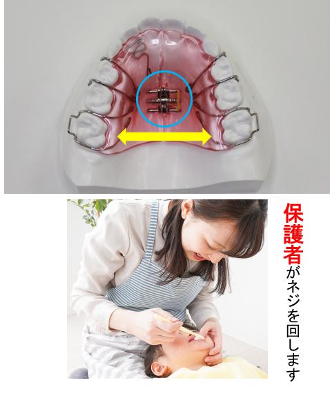 子供は何歳から矯正治療をするべきですか?