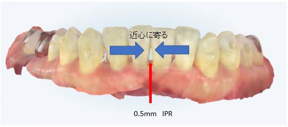 ブラックトライアングルとは?|池袋でマウスピース矯正なら「池袋の歯医者さん みんなの矯正歯科・こども歯科クリニック」