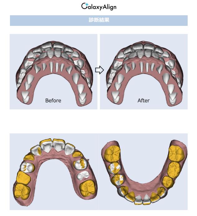 ギャラクシーアラインとは?– 子どもの未来を育てる、小児マウスピース矯正の新基準 –