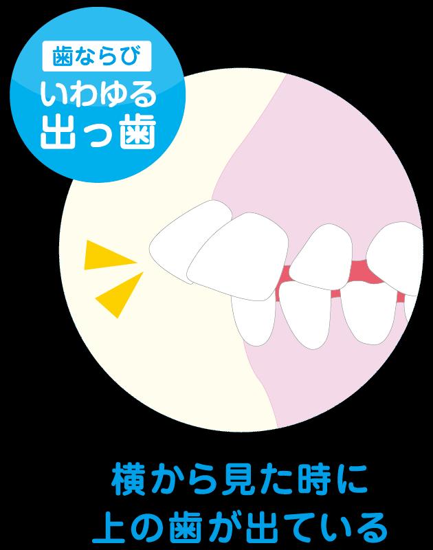 出っ歯の原因と予防方法について：小児矯正の重要性
