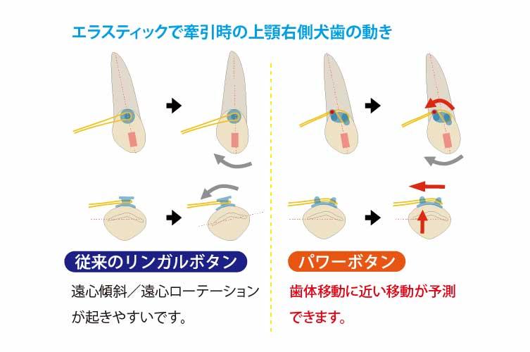 マウスピース矯正 関連グッズ