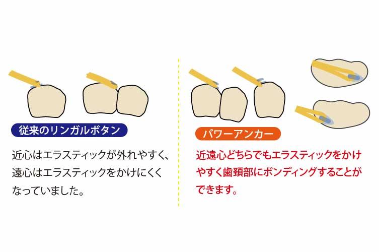 マウスピース矯正 関連グッズ