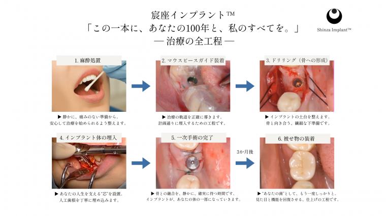 インプラントは1本いくら?──価格の裏にある医術の構えを知っていますか【池袋駅すぐ・宸座インプラント】