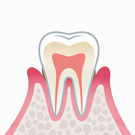 軽度歯周炎