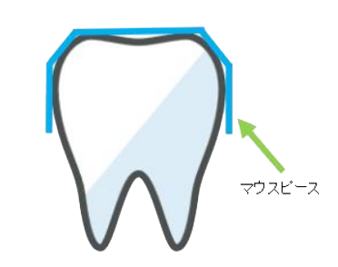 【マウスピース矯正】